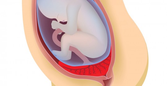 Placenta previa: clínica en el parto y conducta